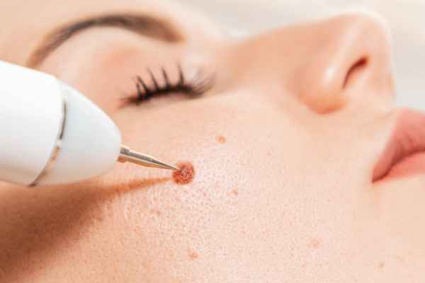 CryoPen: 5 Skin Concerns It May Be Used to Treat 3 What actually happens during a CryoPen treatment Barnet?