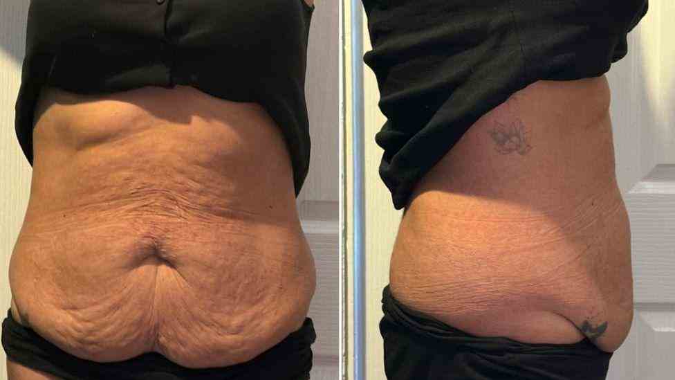 Lost the Weight but Not the Loose Skin? What You Should Know 1 Is It Definitely Loose Skin Barnet?